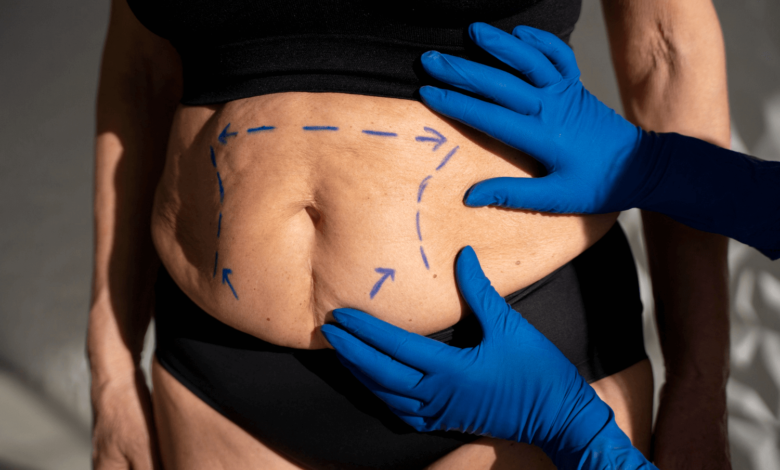 Karın Germe Abdominoplasti Docintur