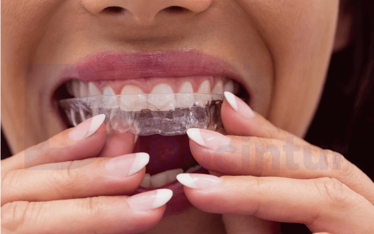 Braces vs Clear Aligners