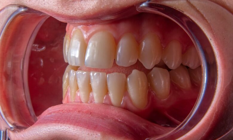 Side view close-up of a patient's mouth with full mouth dental implants installed in Turkey, 2025.